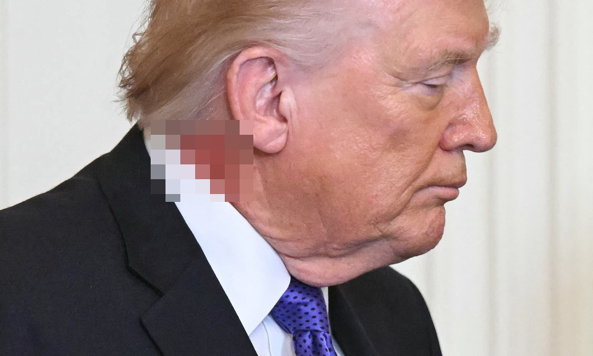 Trump causa novas preocupações com a saúde enquanto espectadores notam “problema desagradável” no pescoço dele