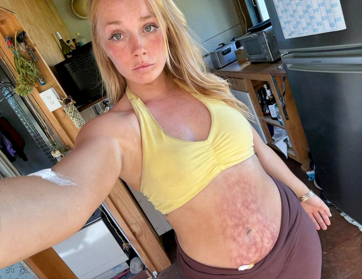 Uso garrafas de água quente diariamente para cólicas menstruais – elas me deixaram com cicatrizes