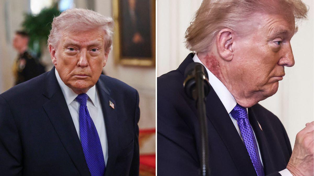 Erupção na nuca de Donald Trump: Médicos alertam sobre o risco de manter a condição da pele em segredo